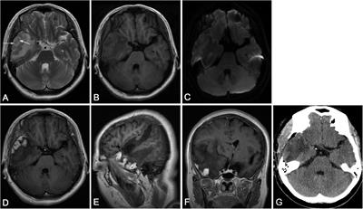 The Application of MR Spectroscopy and MR Perfusion in Cerebral Syphilitic Gumma: A Case Report